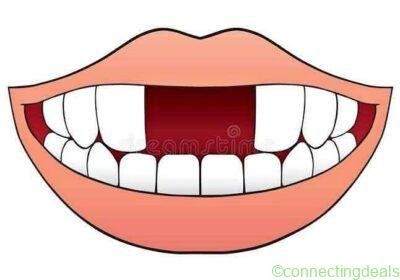 Mr Gap Repairs Tooth Fixer in Durban