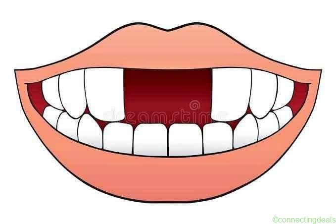 Mr Gap Repairs Tooth Fixer